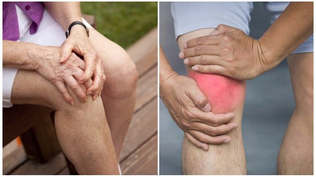 Symptoms of Artrosis