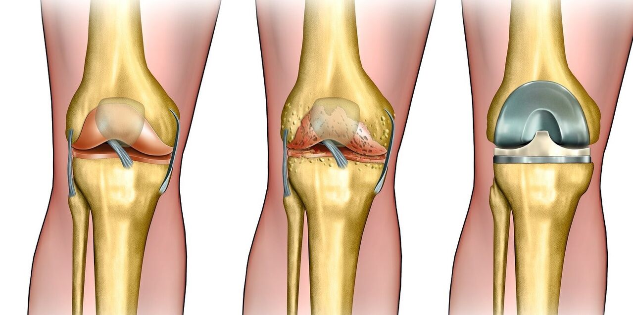 What is Arthroz