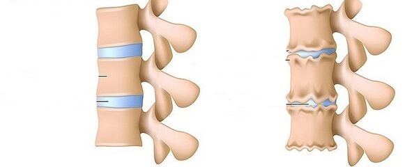 a healthy spine and osteochondrosis