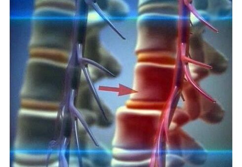 Compression of nerve endings in lumbar osteochondrosis