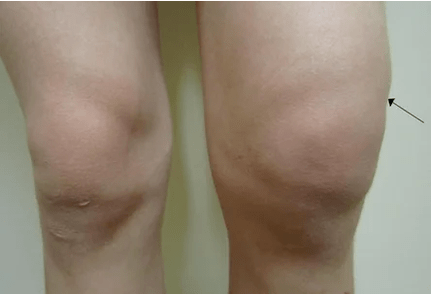 Hemetriosis of knee joint