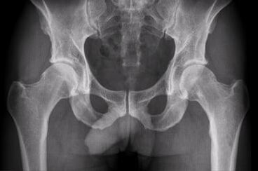 Diagnostic options for arthrosis of hip combination