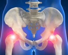 Reasons for arthrosis of hip combination