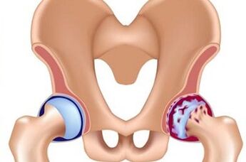 Stages of development of arthrosis of hip combination