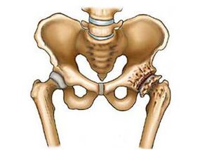 What is artrosis of hip joint