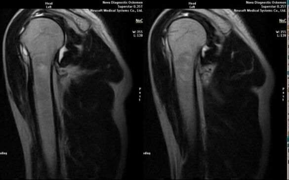 X-ray to diagnose shoulder arthrosis